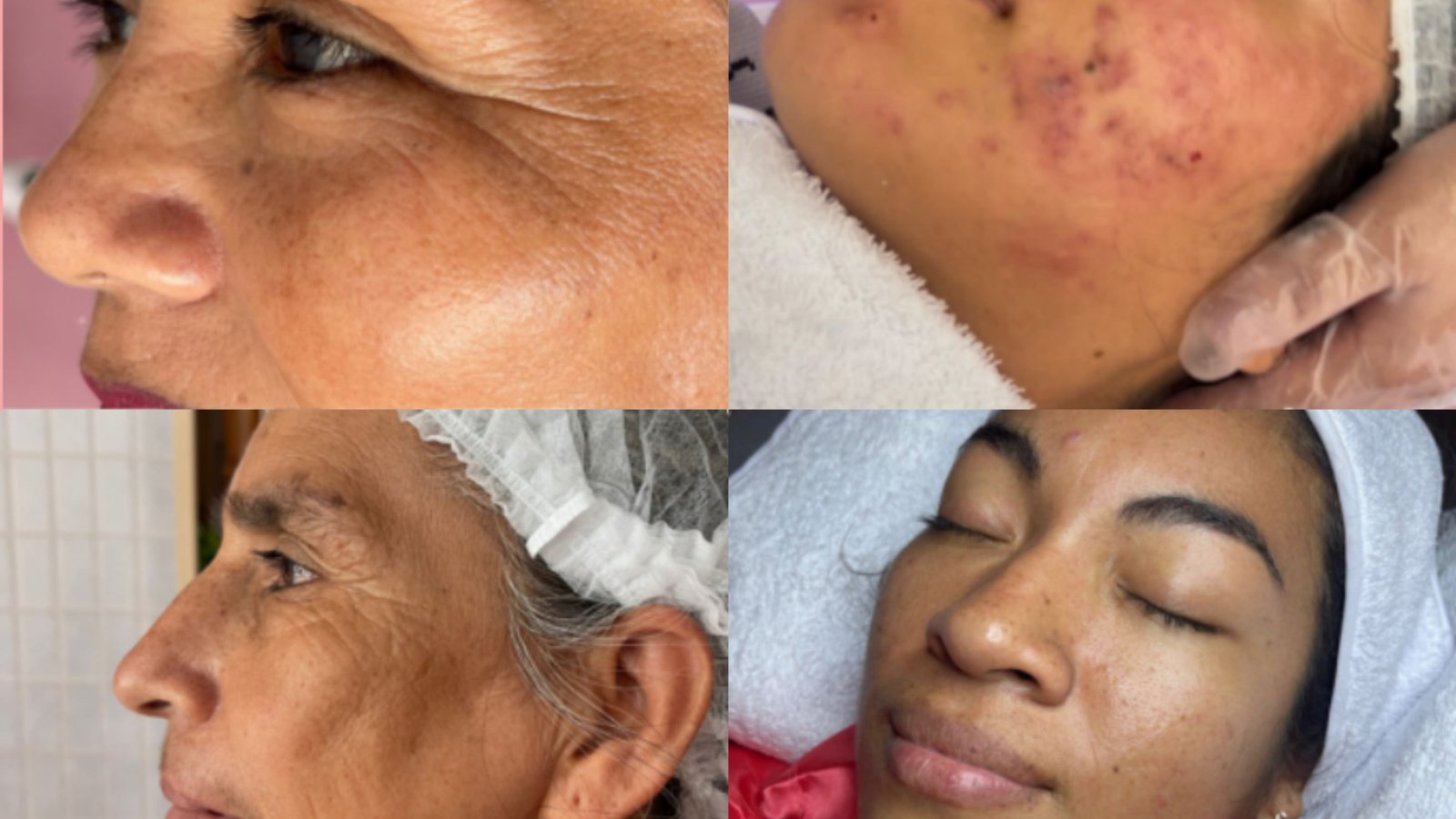 Antes del tratamiento facial